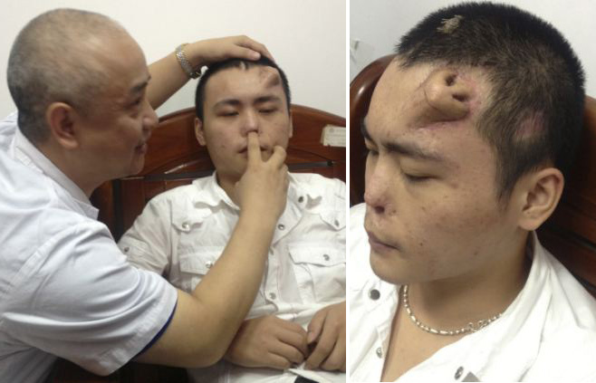 Hidung Baru `Tumbuh` di Dahi Pria China